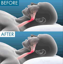 The Quiet Anti-Snoring Mouthpiece (Universal Size)